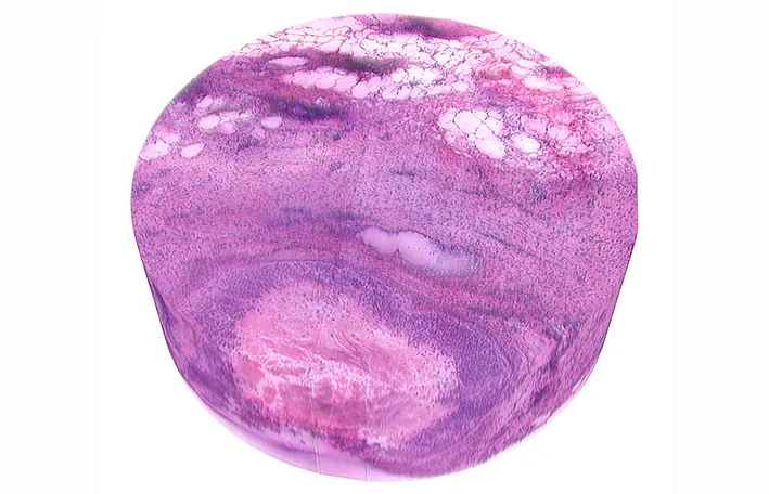 Breast cancer histology